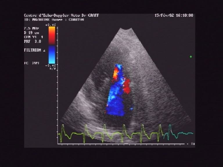 Insuffisance mitrale suite  une dilatation de l'anneau mitral: fuite centrale.