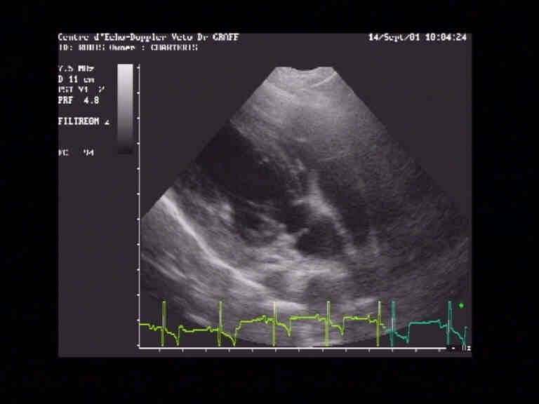 Sous la valve aortique, dans la chambre de chasse se trouve un obstacle  l'ejection du ventricule gauche: cet obstacle se trouve sur la photo au dessus du plan des valves aortiques